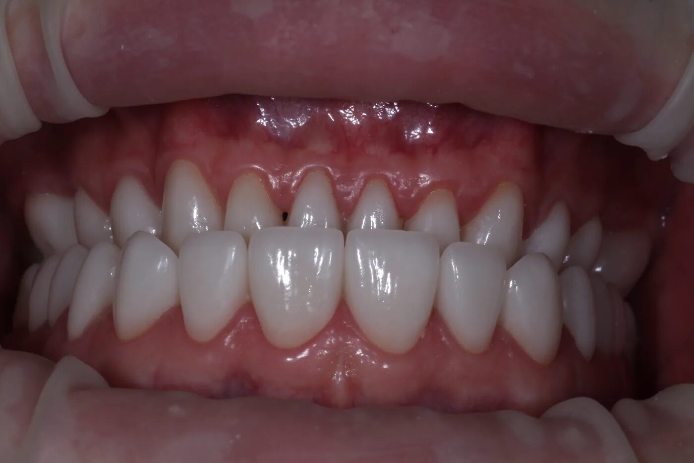 Full-mouth rehabilitation, 28 teeth. After