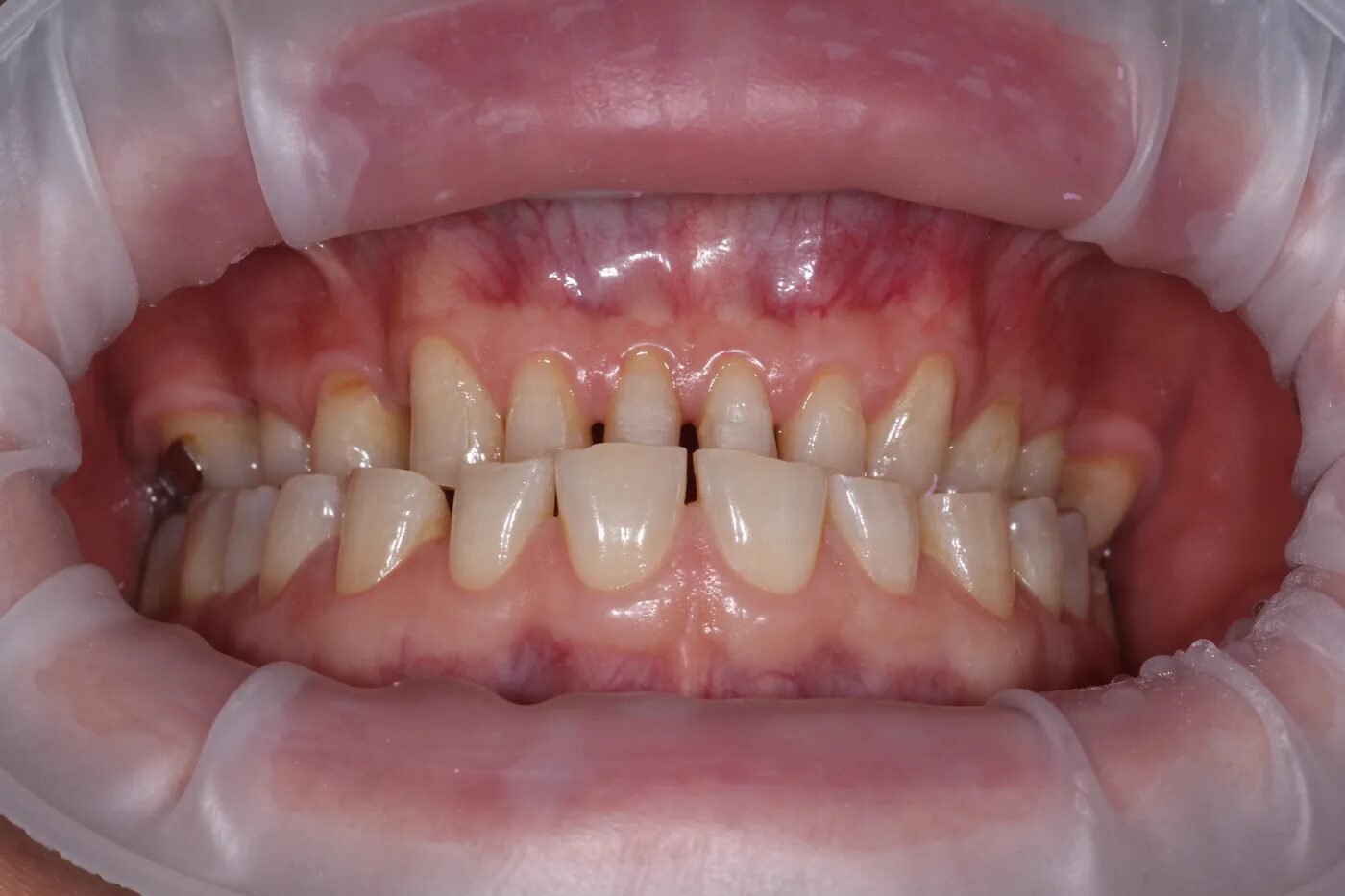 Full-mouth rehabilitation, 28 teeth. Before