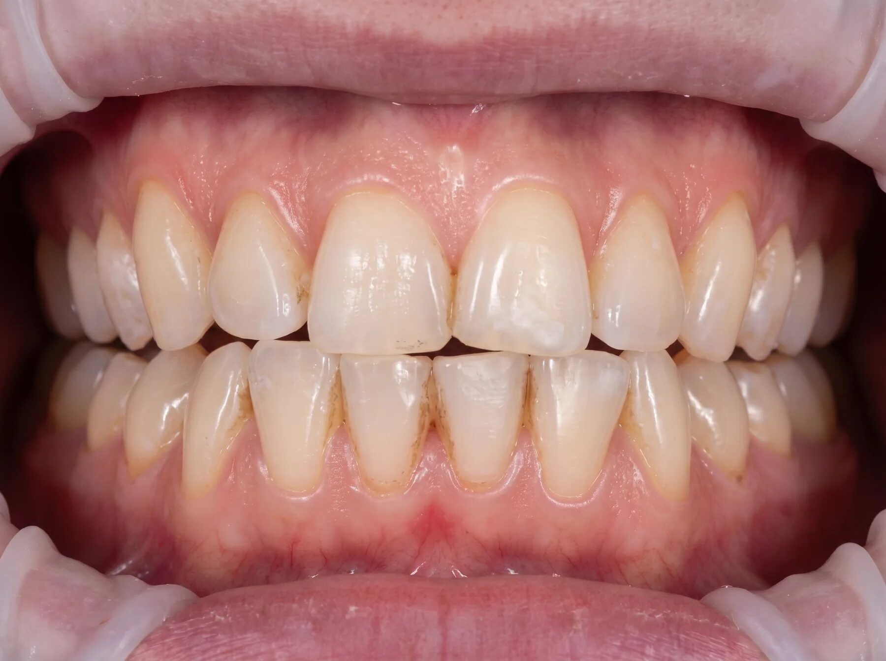 Professional hygiene. Before